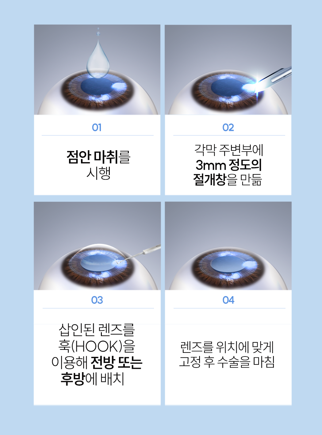 렌즈삽입술