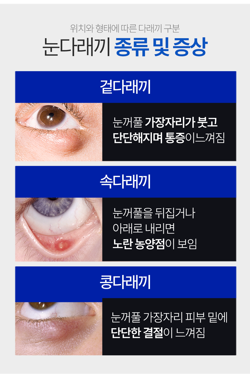 눈다래끼